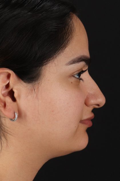 Rhinoplasty Before & After Patient #12436