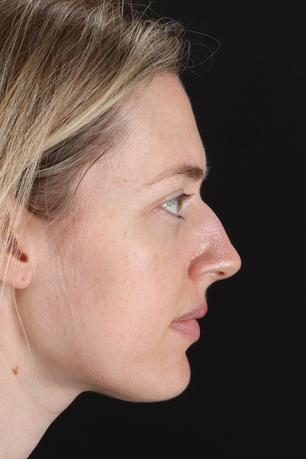 Rhinoplasty Before & After Patient #12227