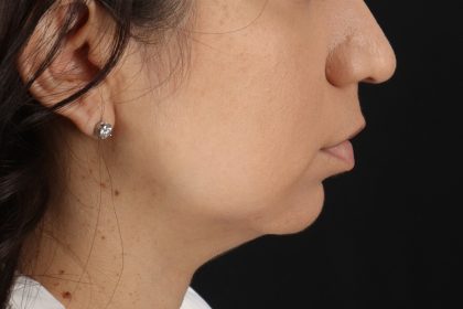 Chin Implant Before & After Patient #13783