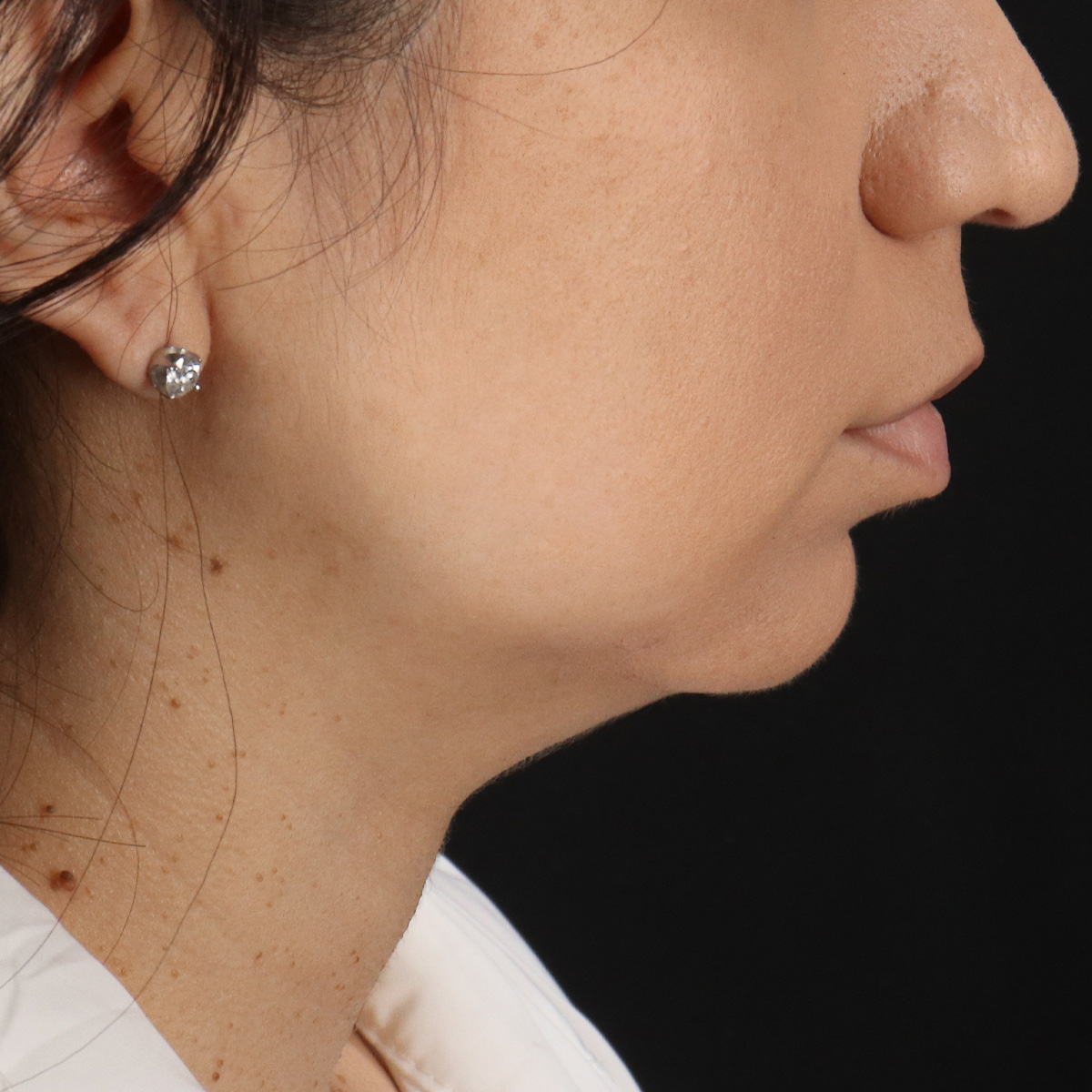 Neck Lift Before & After Patient #14047