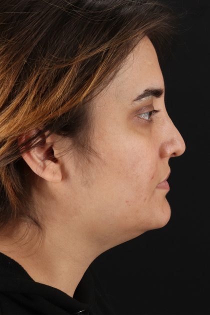 Neck Lift Before & After Patient #11565