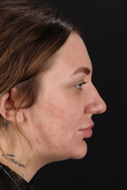 Rhinoplasty Before & After Patient #12403