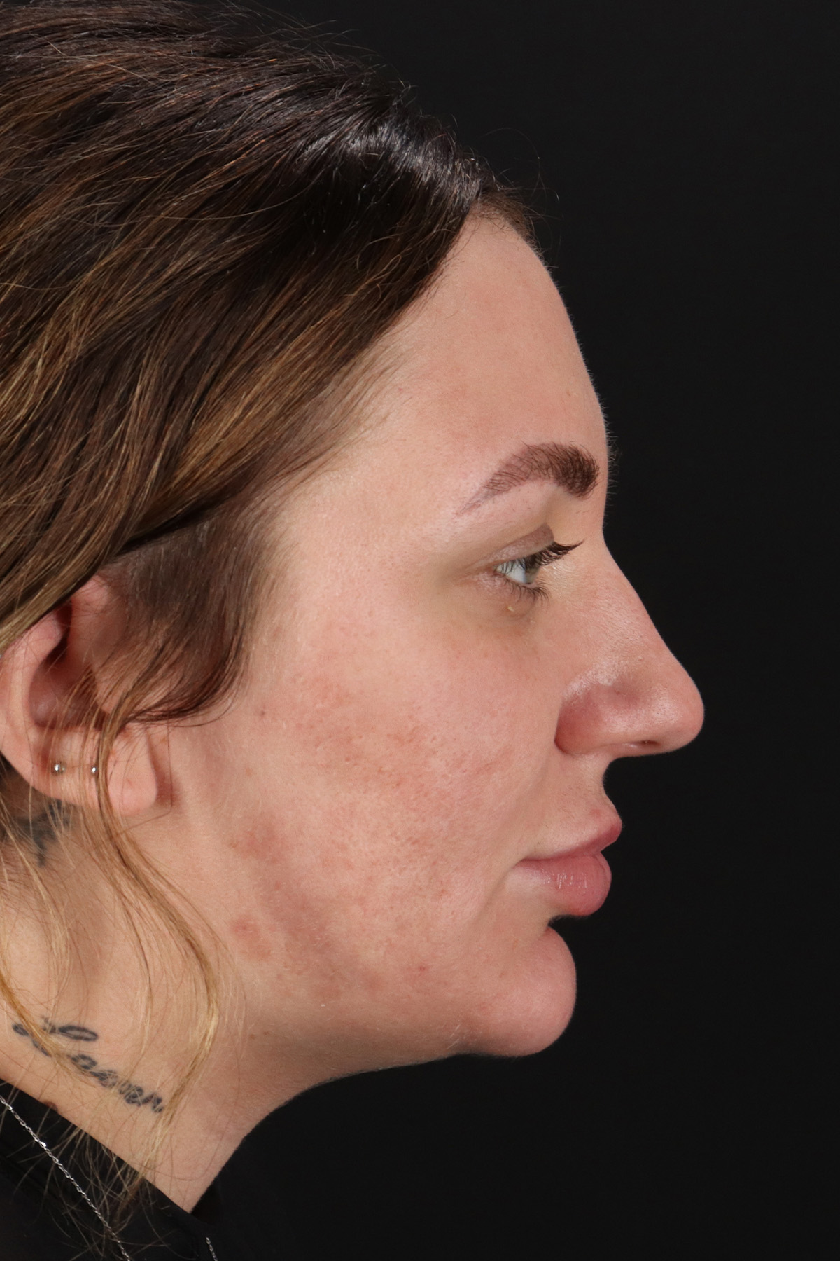 Rhinoplasty Before & After Patient #12403