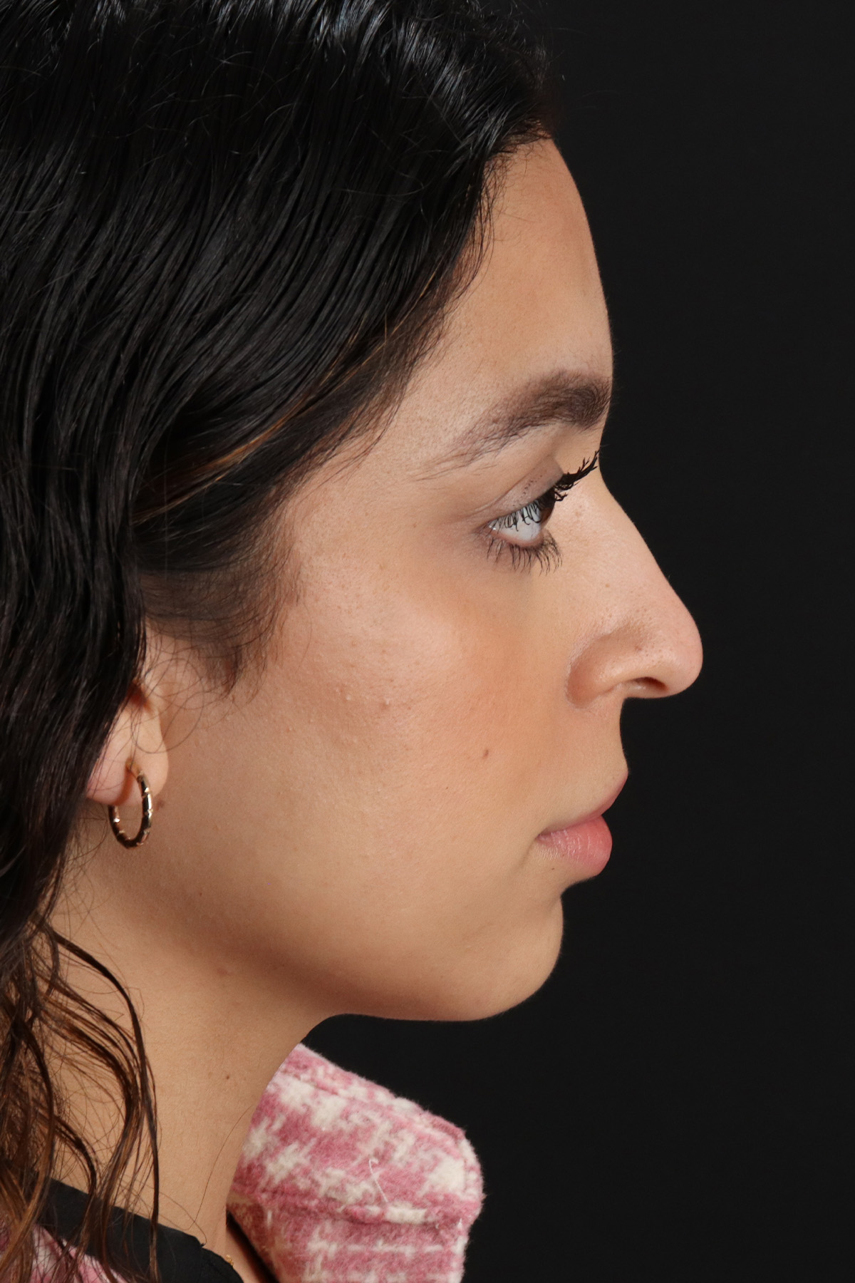 Rhinoplasty Before & After Patient #12249