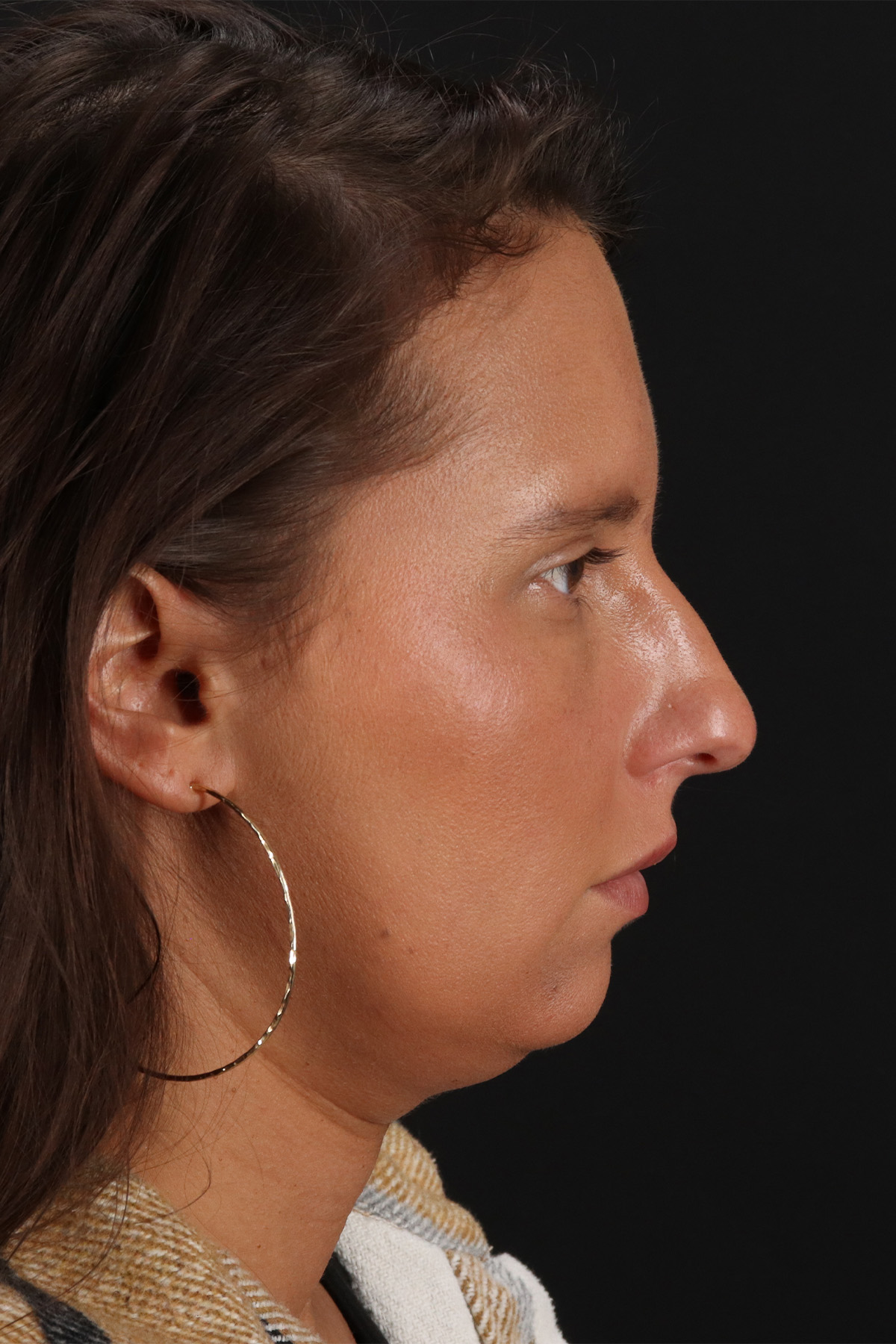 Chin Implant Before & After Patient #13728