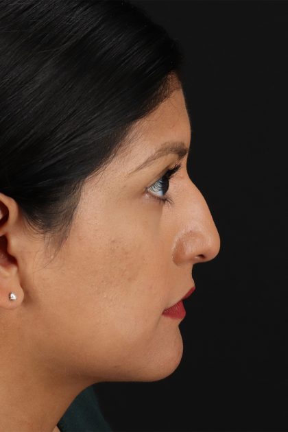 Rhinoplasty Before & After Patient #12337