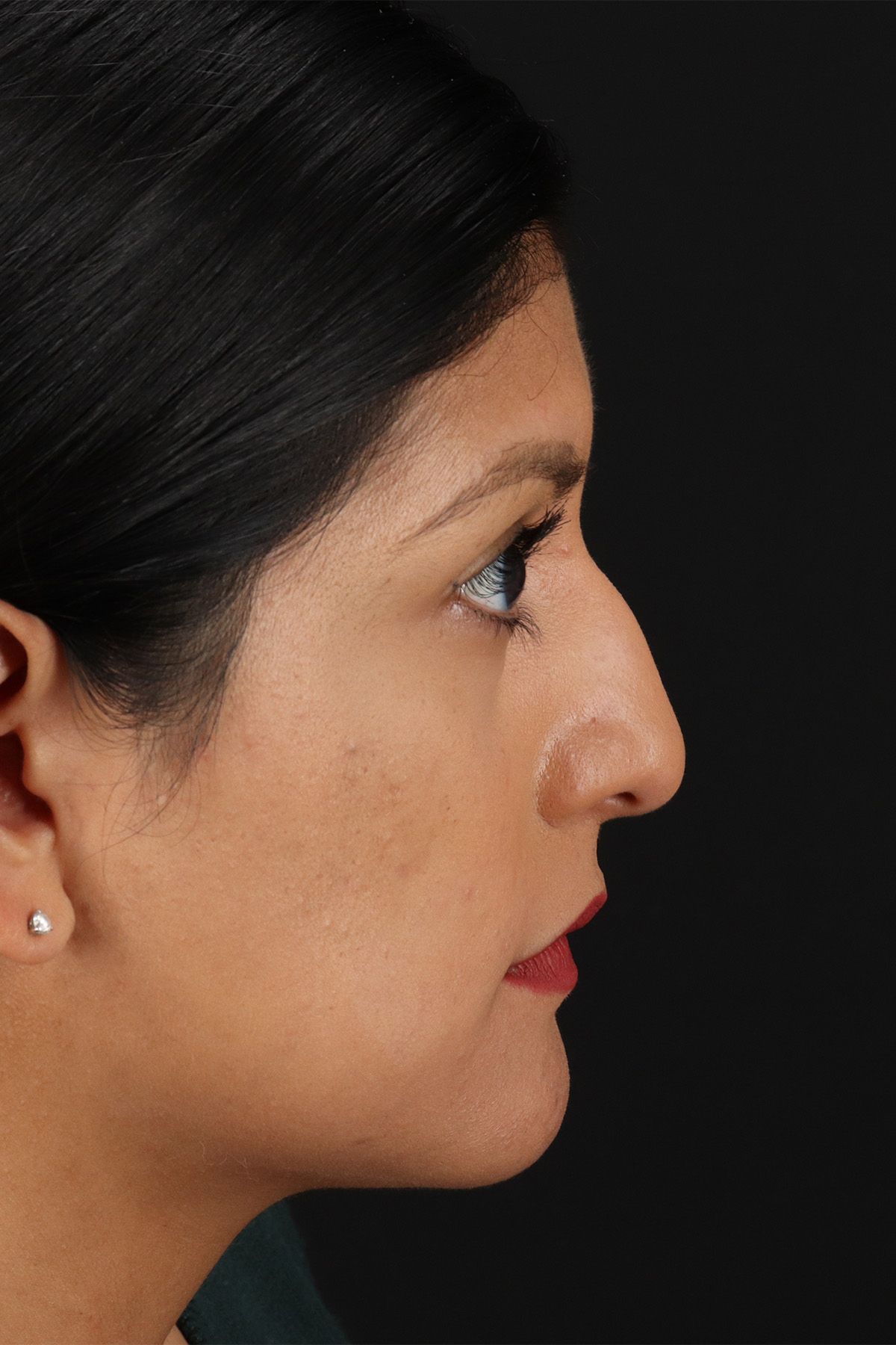 Rhinoplasty Before & After Patient #12337
