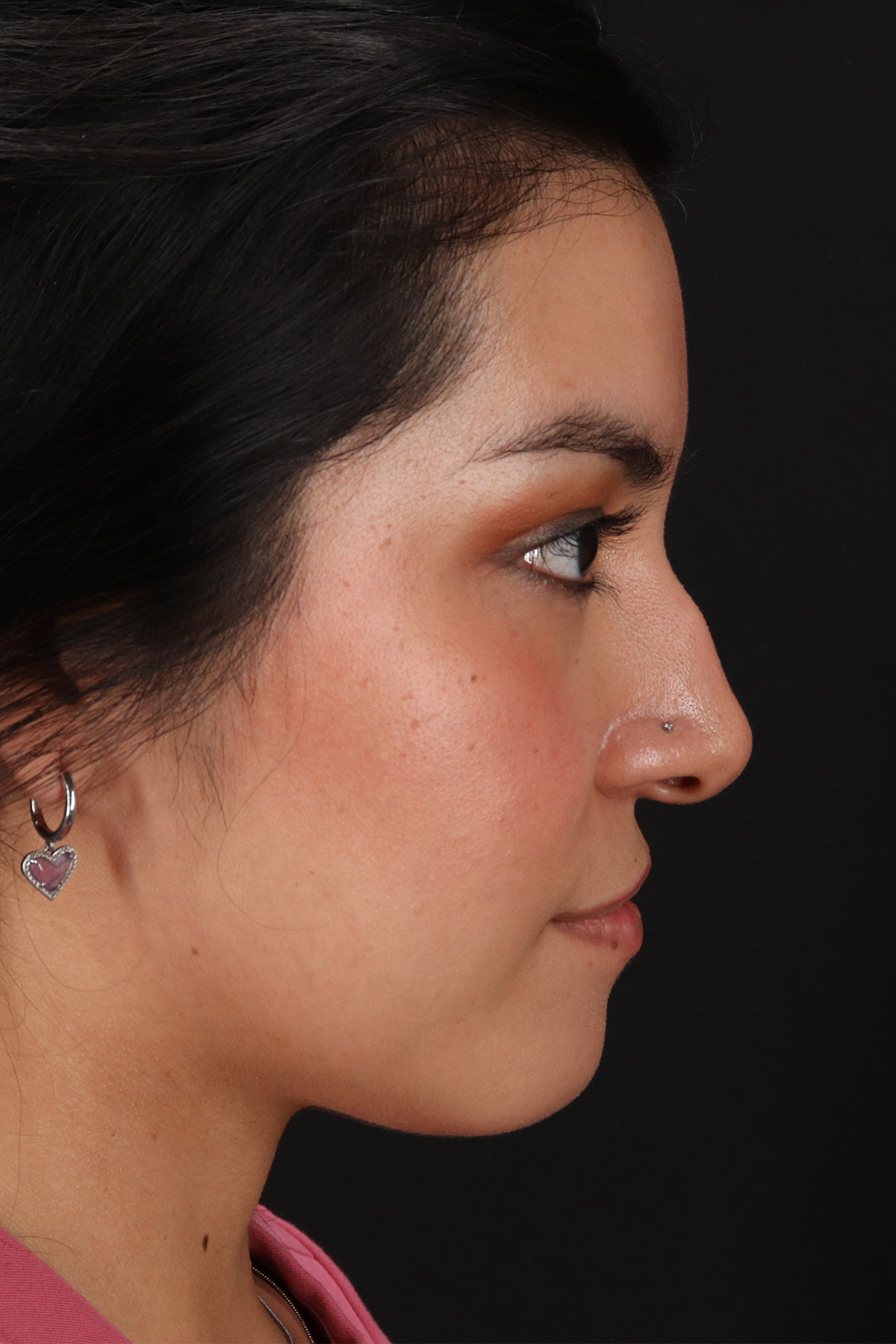Fillers Before & After Patient #13298