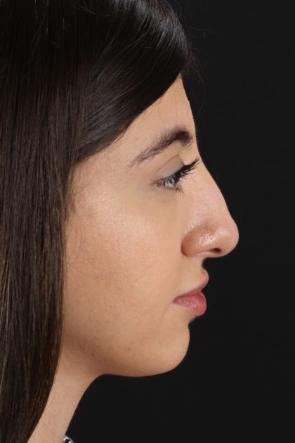 Rhinoplasty Before & After Patient #12304