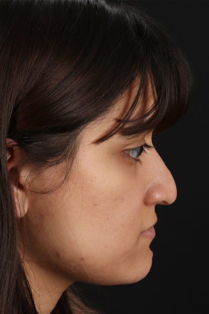Rhinoplasty Before & After Patient #12469