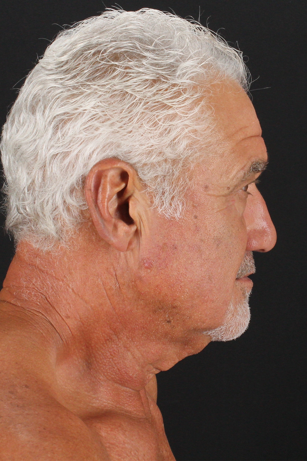 Lower Blepharoplasty Before & After Patient #13096