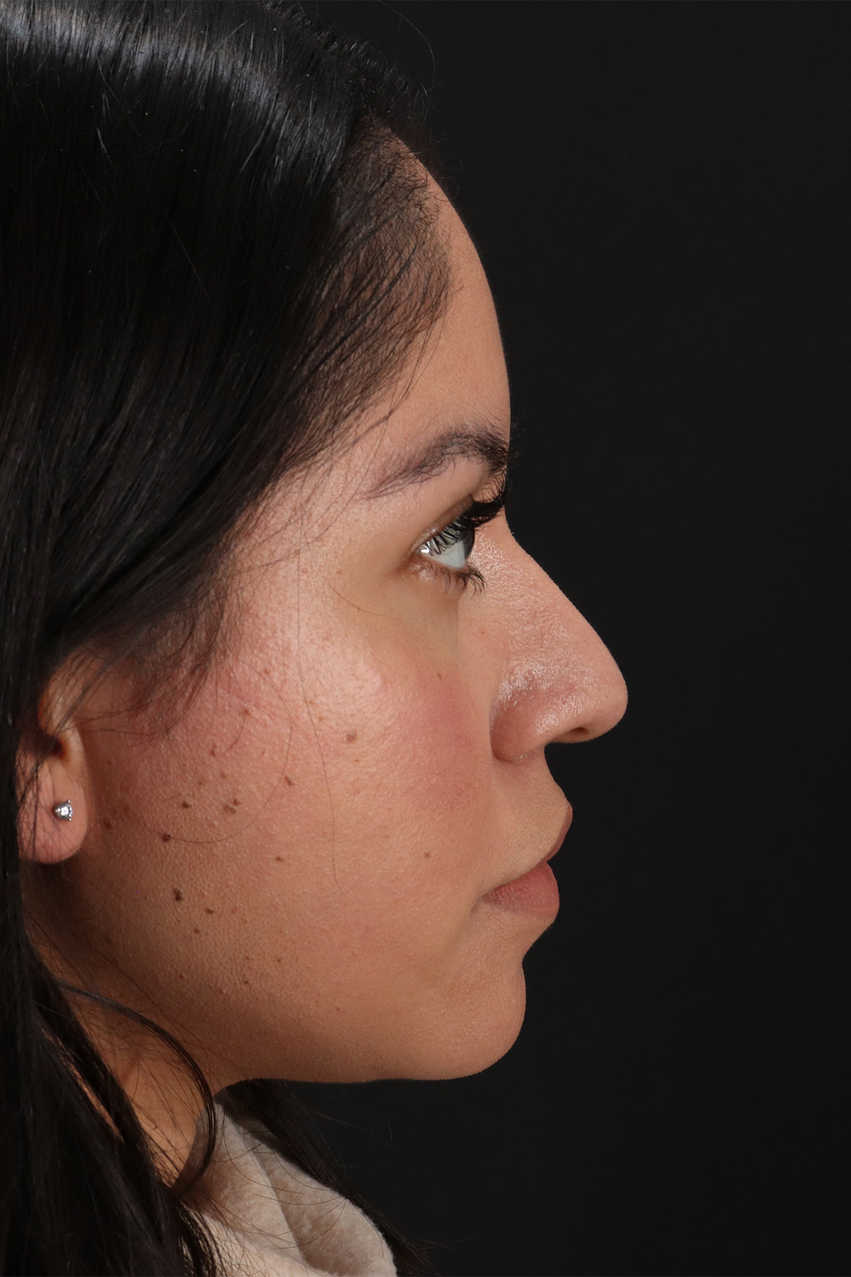 Fillers Before & After Patient #13276