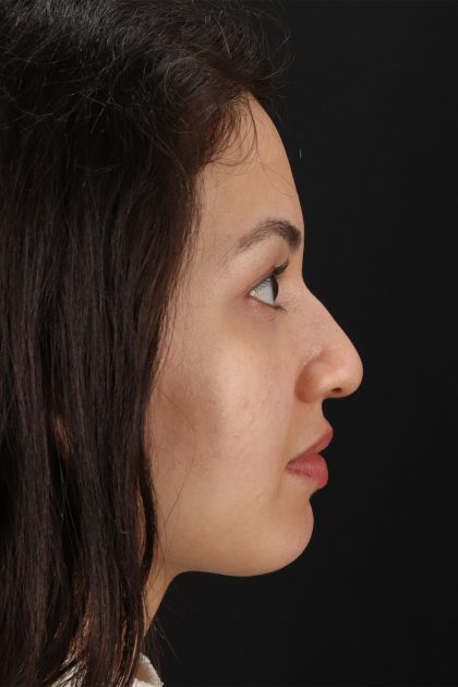 Rhinoplasty Before & After Patient #12282