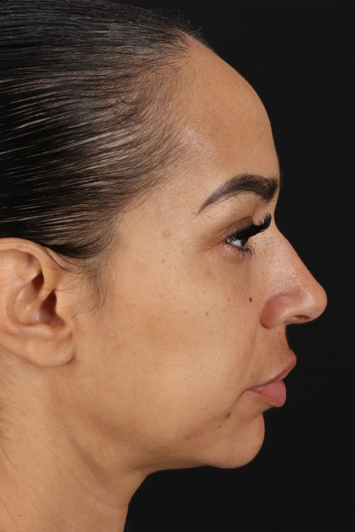 Chin Implant Before & After Patient #11693