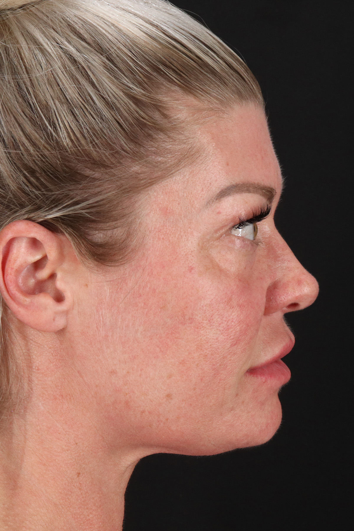 Lower Blepharoplasty Before & After Patient #13030