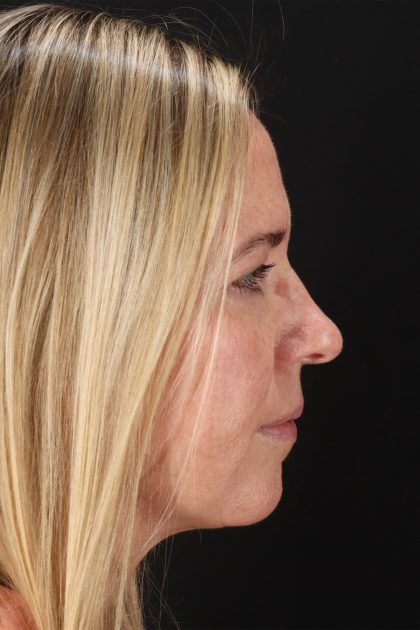 Upper Blepharoplasty Before & After Patient #12029