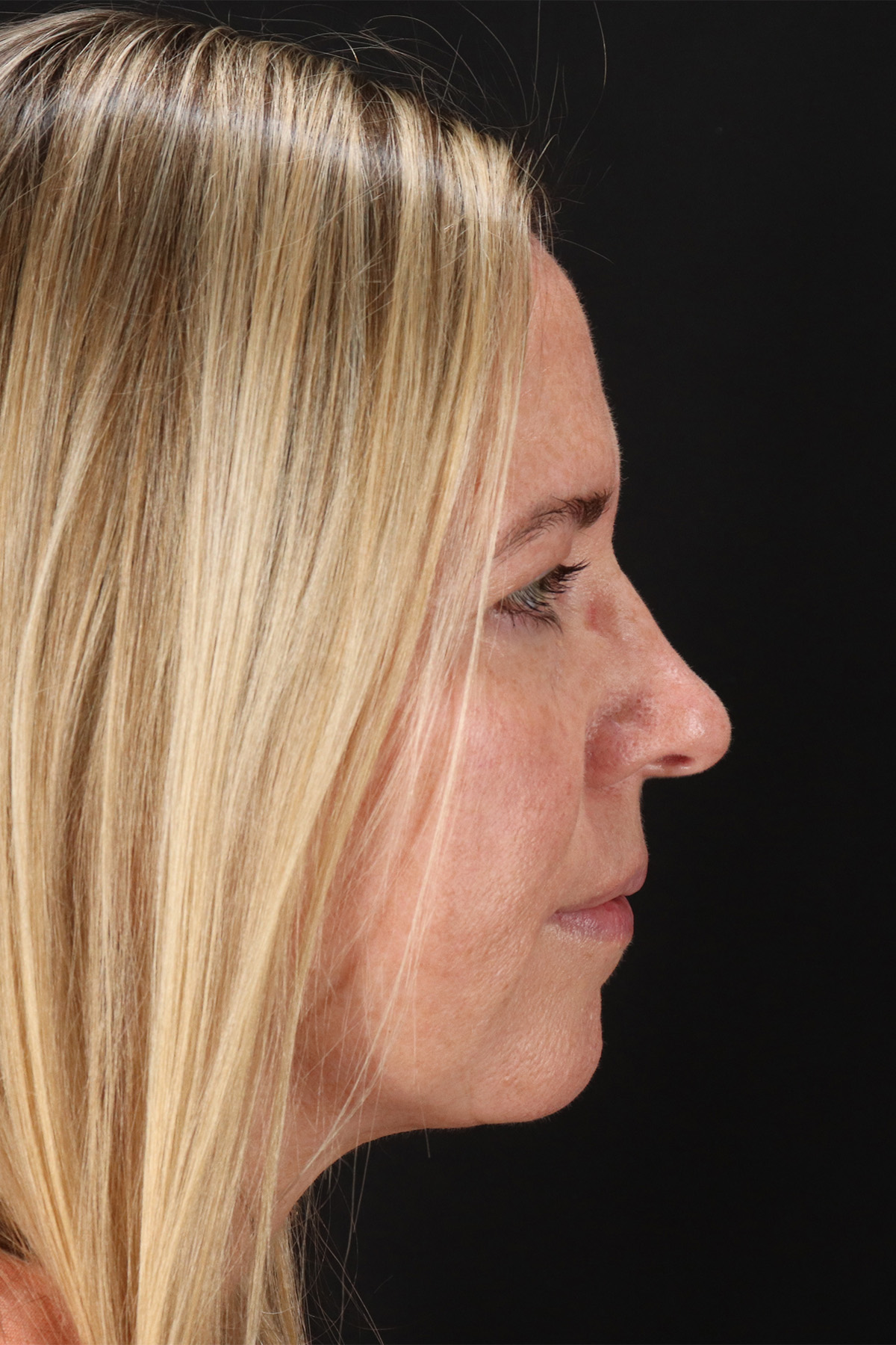 Lower Blepharoplasty Before & After Patient #13041