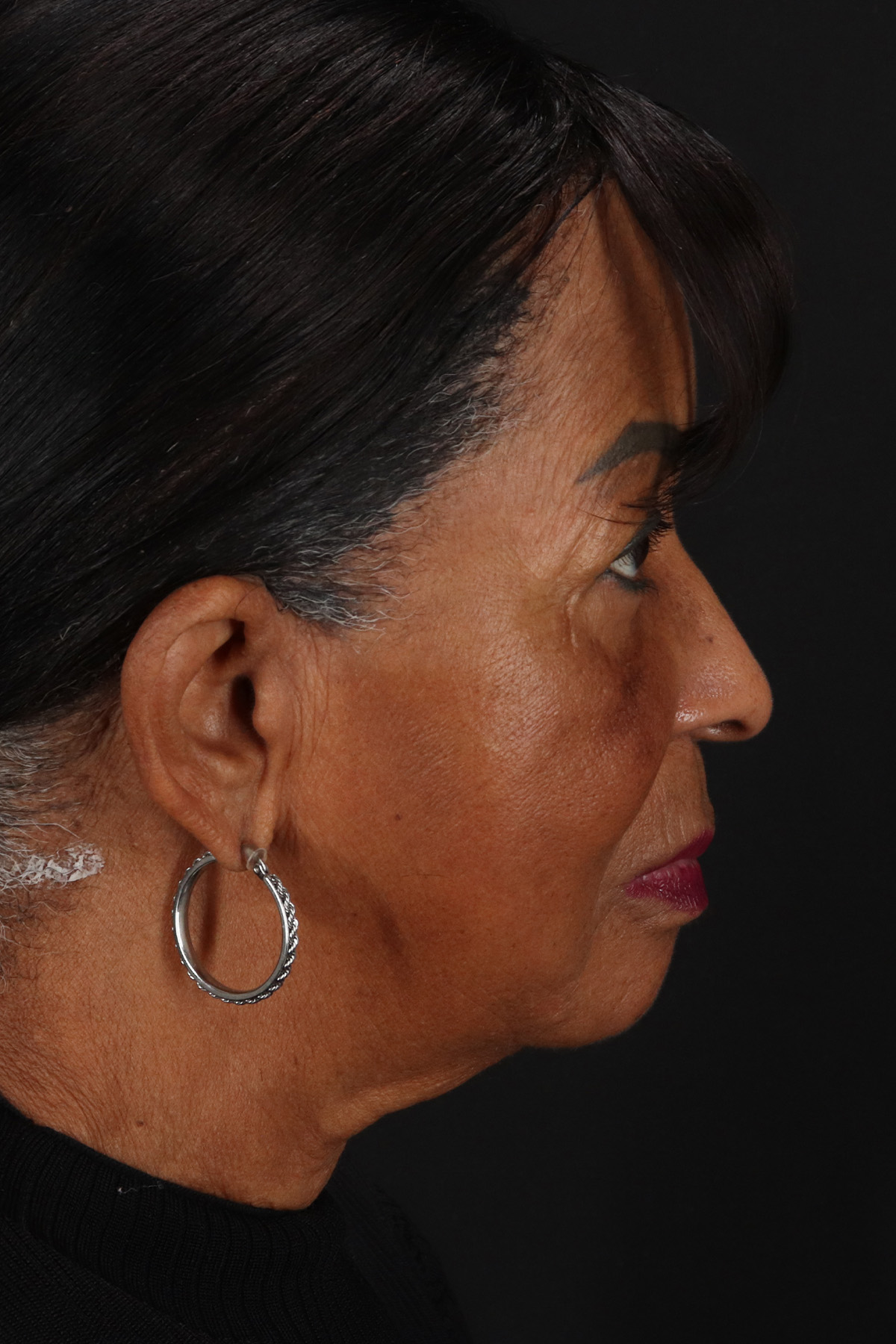 Chin Implant Before & After Patient #13695