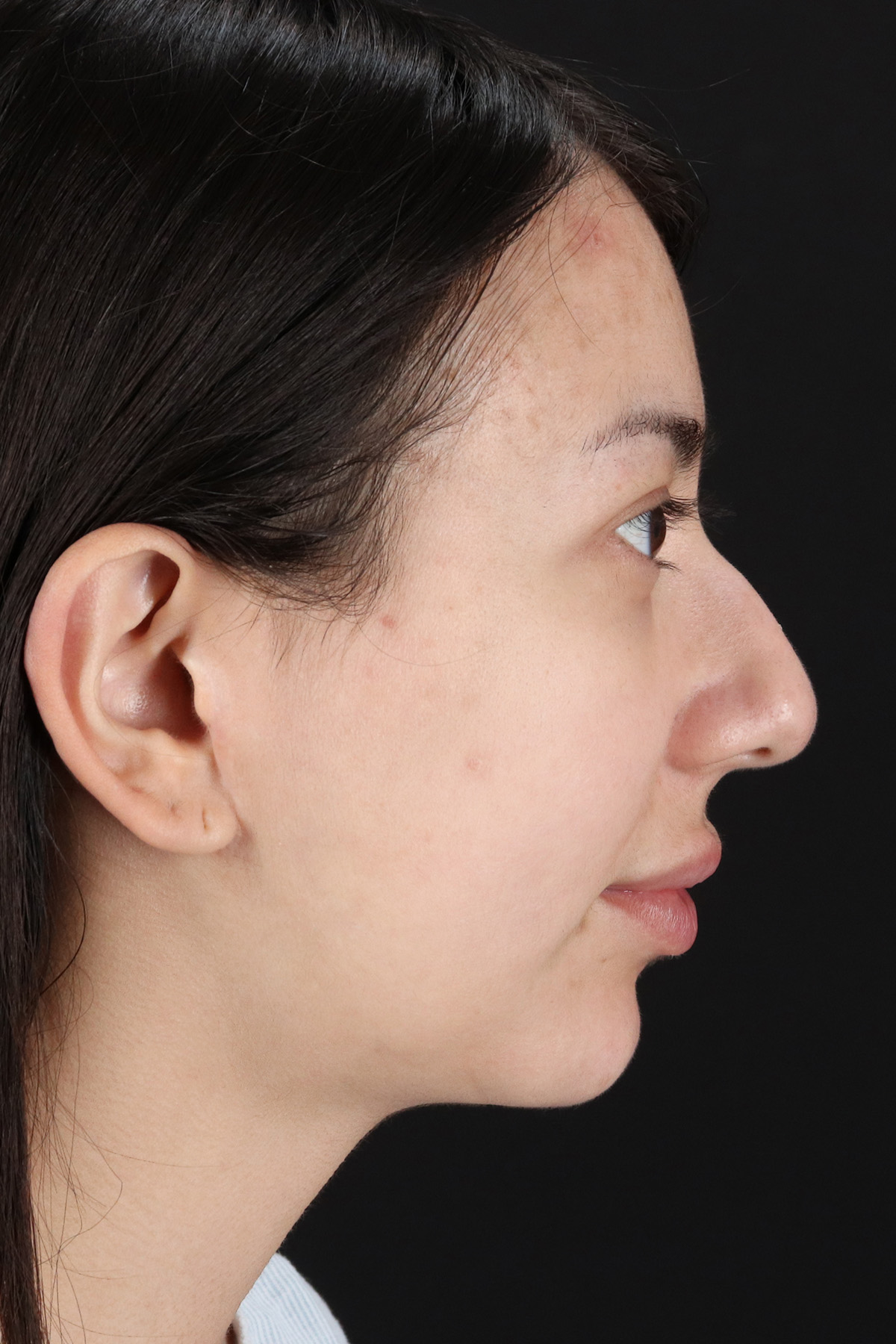 Rhinoplasty Before & After Patient #12359