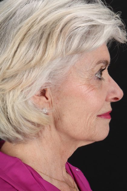 Upper Blepharoplasty Before & After Patient #14036