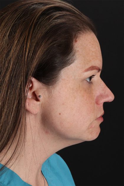 Chemical Peels Before & After Patient #11070