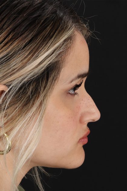 Rhinoplasty Before & After Patient #12260