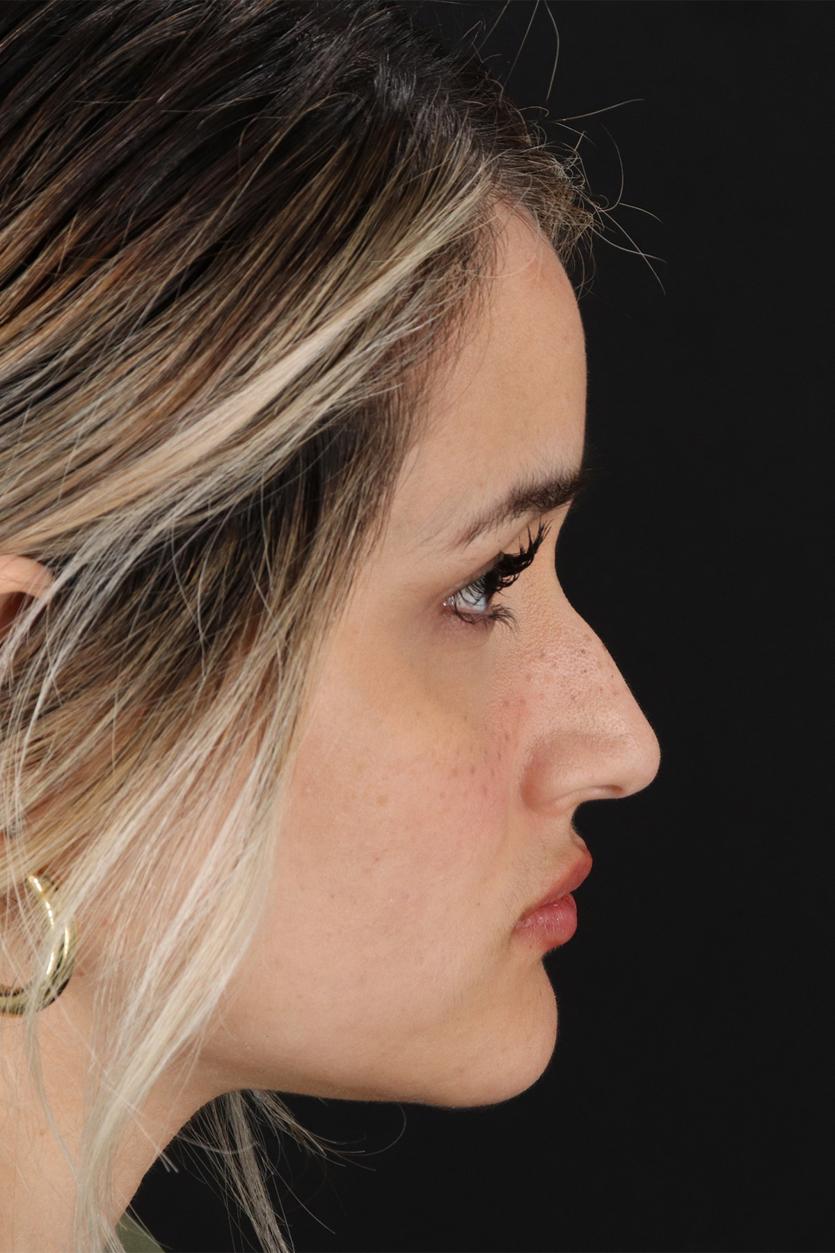 Rhinoplasty Before & After Patient #12260