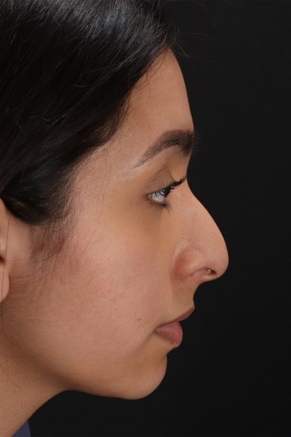 Chin Implant Before & After Patient #13706