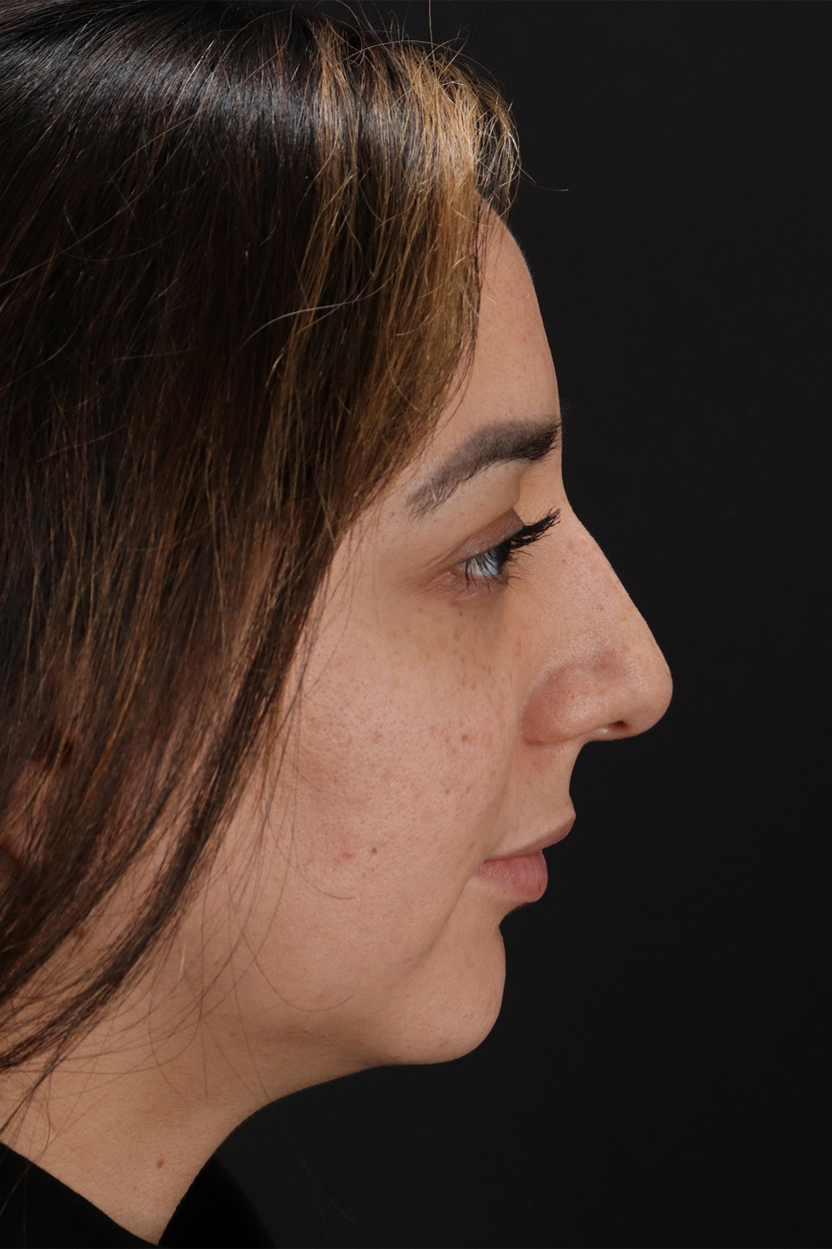 Rhinoplasty Before & After Patient #12392