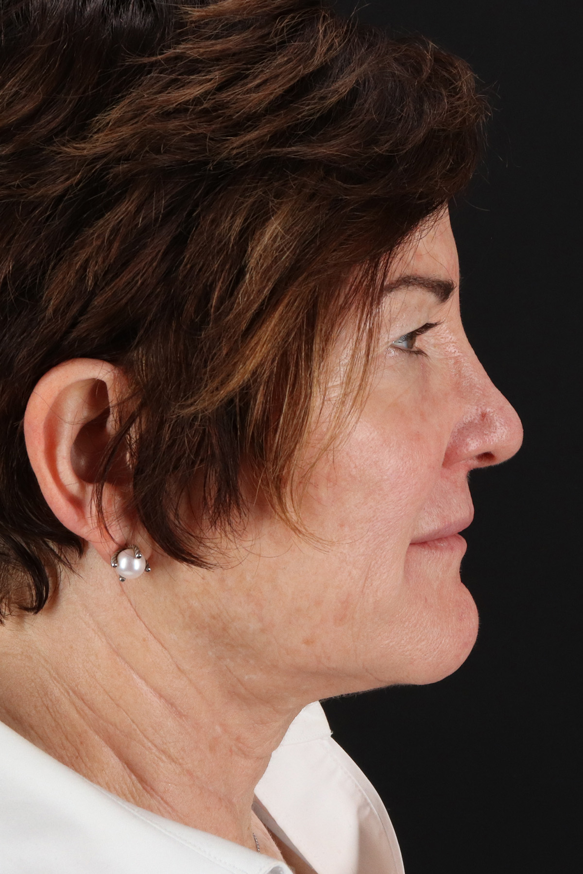 CO2 Laser Before & After Patient #11872