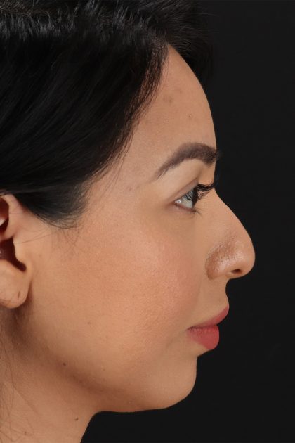 Chin Implant Before & After Patient #13717