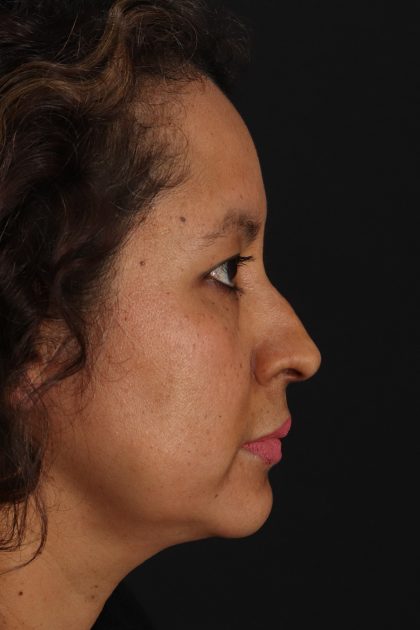 Rhinoplasty Before & After Patient #12293