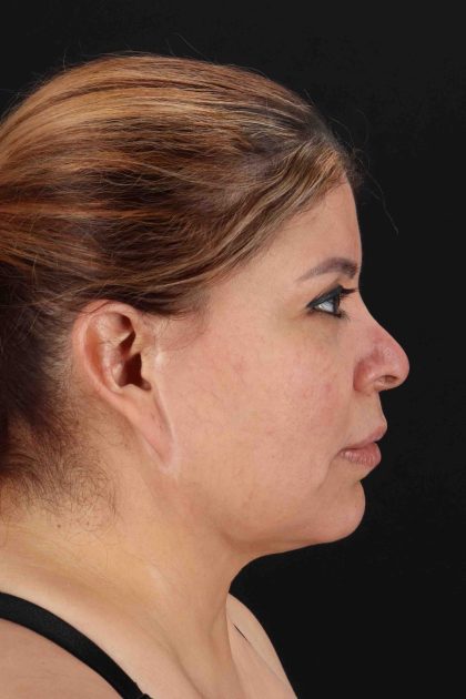 Fat Grafting To The Face Before & After Patient #11850