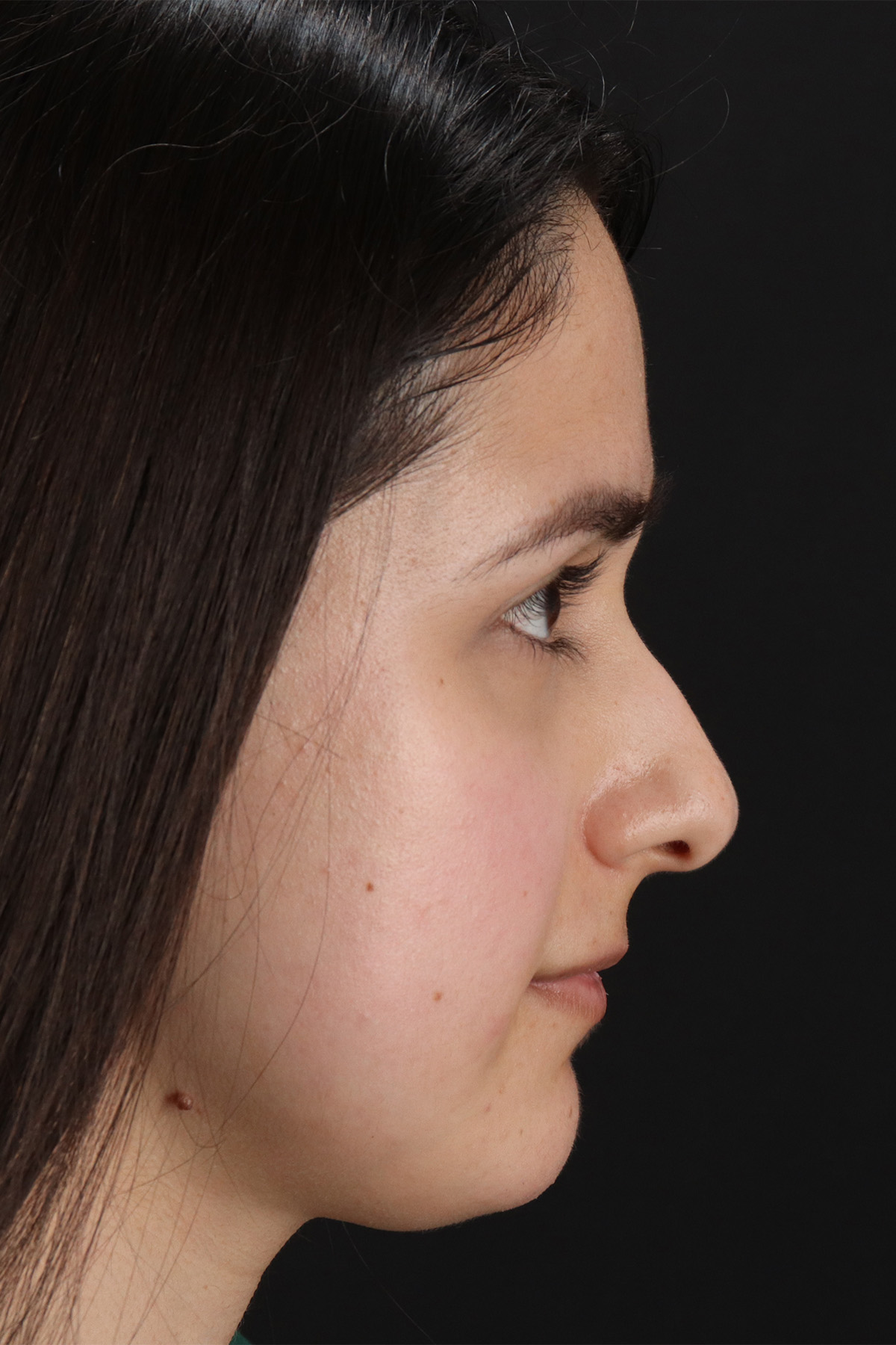 Liquid Rhinoplasty Before & After Patient #11339