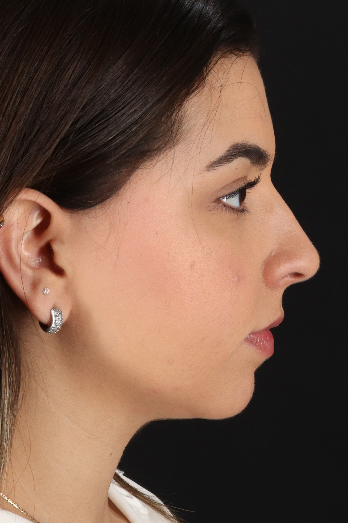 Chin Implant Before & After Patient #11694