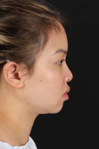 Chin Implant Before & After Patient #13816