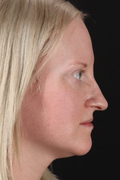 Rhinoplasty Before & After Patient #12381