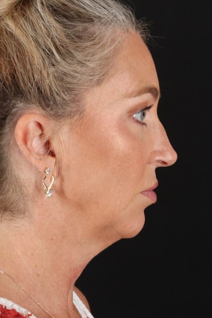 Upper Blepharoplasty Before & After Patient #12084