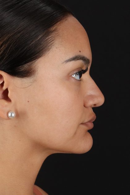 Rhinoplasty Before & After Patient #12326
