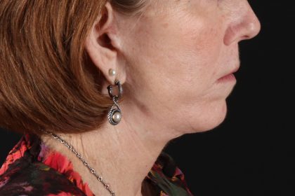 Neck Liposuction Before & After Patient #12117