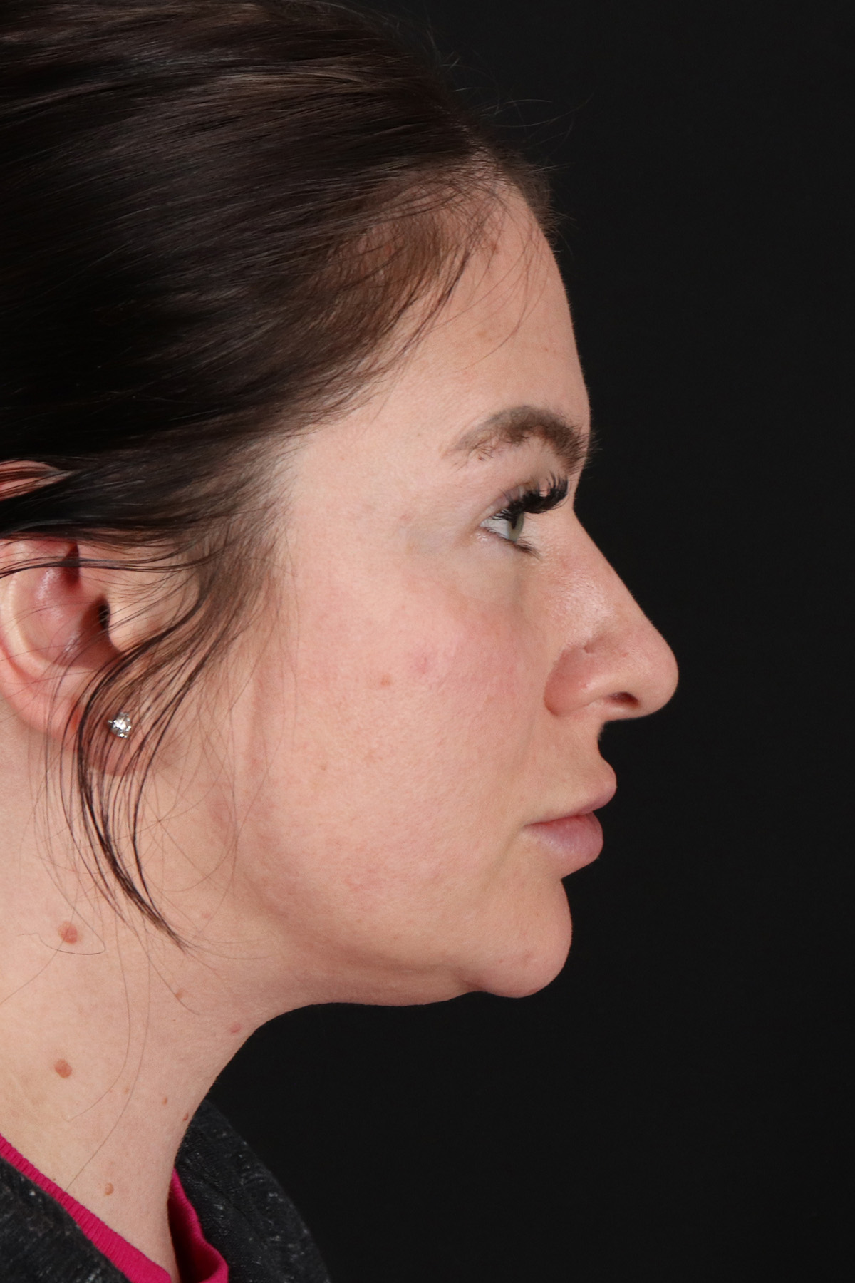 Rhinoplasty Before & After Patient #12414