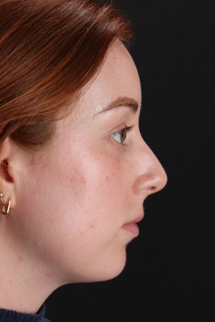 Rhinoplasty Before & After Patient #12348