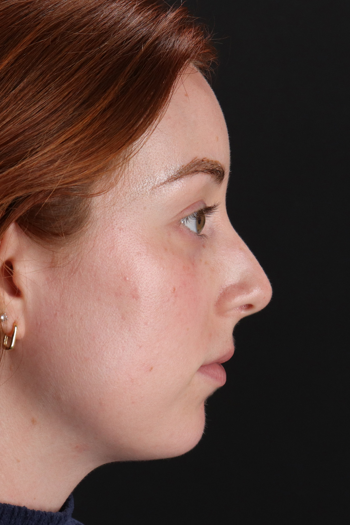 Rhinoplasty Before & After Patient #12348