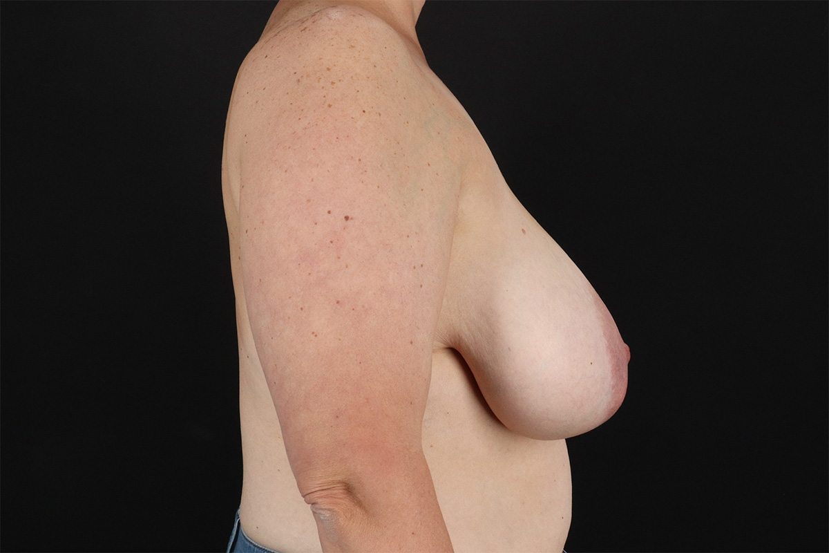 Breast Reduction With Lift Before & After Patient #10969