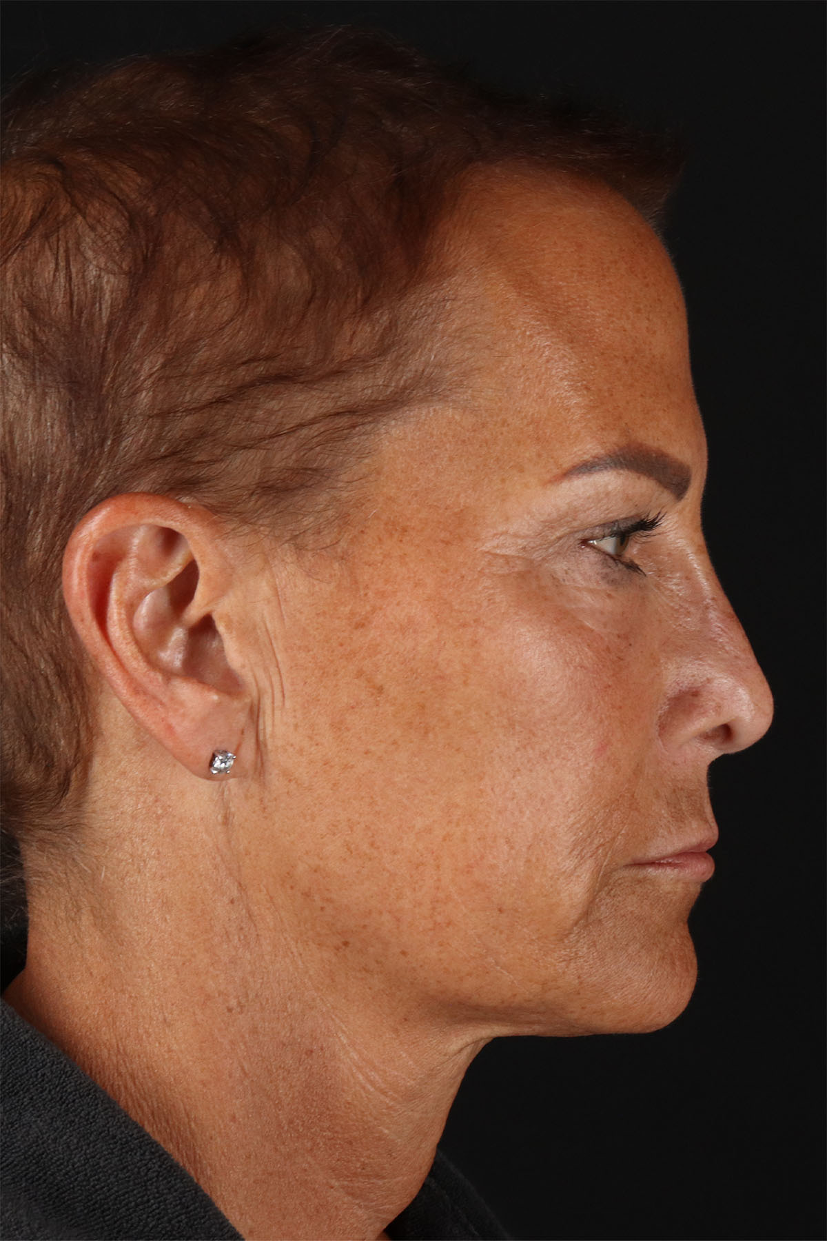 CO2 Laser Before & After Patient #10980