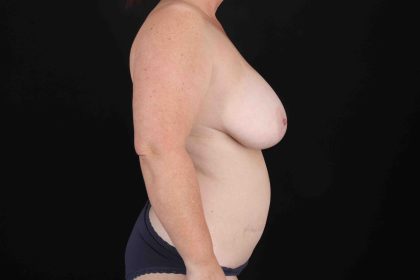 Mommy Makeover Before & After Patient #11938