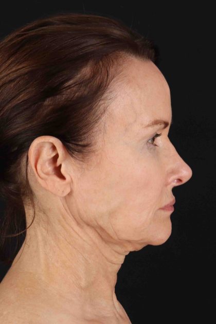 Fat Grafting To The Face Before & After Patient #11839