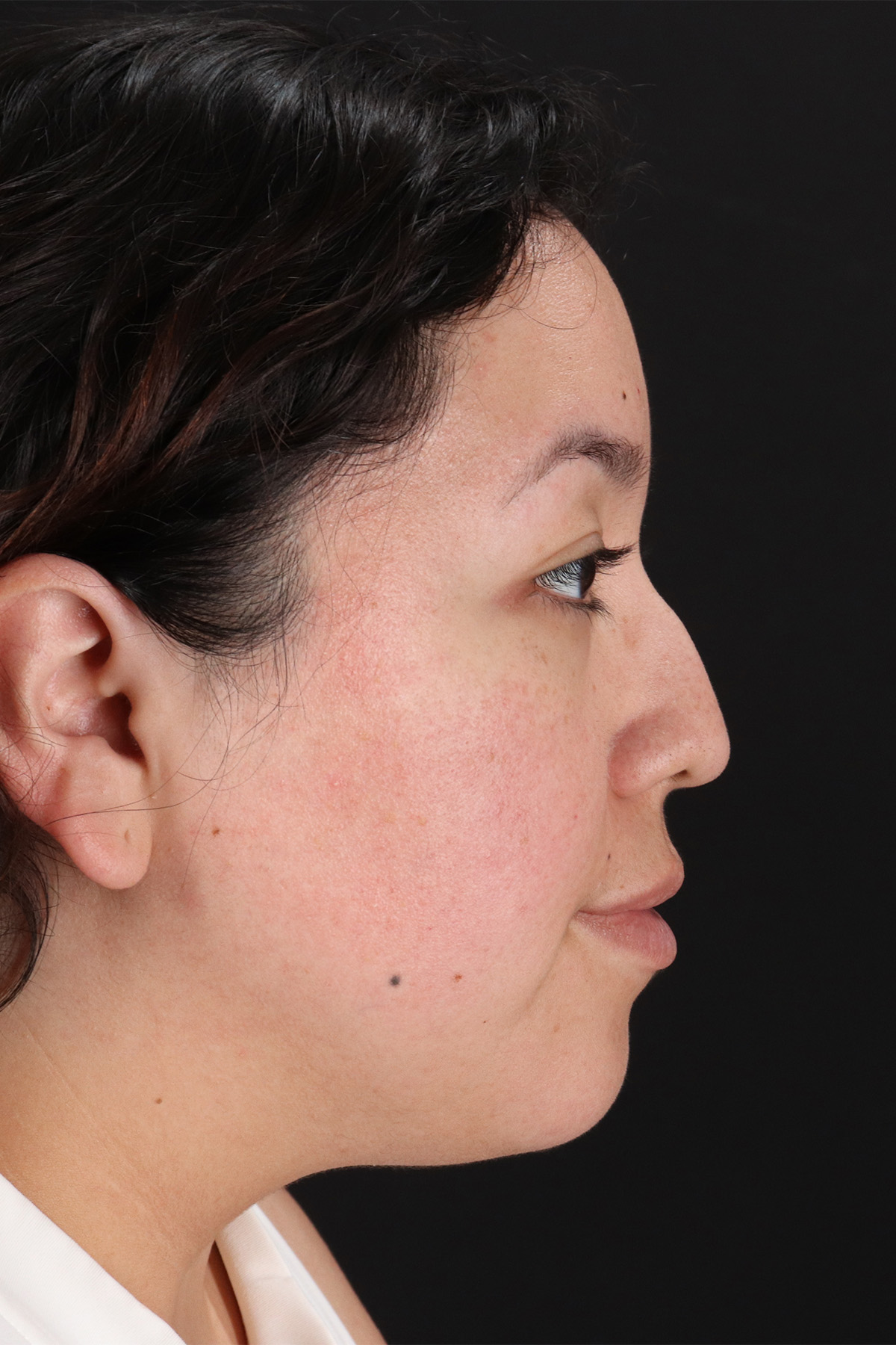 Rhinoplasty Before & After Patient #12447