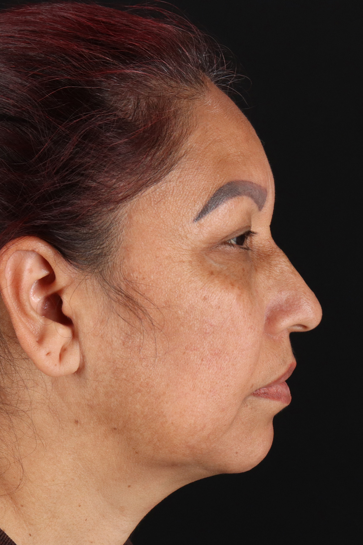 Lower Blepharoplasty Before & After Patient #13085