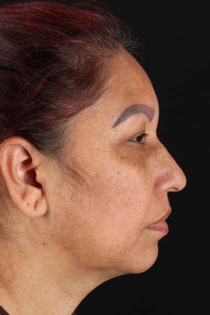 Upper Blepharoplasty Before & After Patient #12051